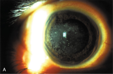 Phototherapeutic Keratectomy (PTK) And Intralamellar PTK | Ento Key