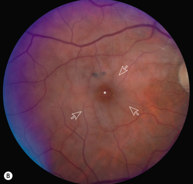 Visual Loss: Retinal Disorders Of Neuro-Ophthalmic Interest | Ento Key