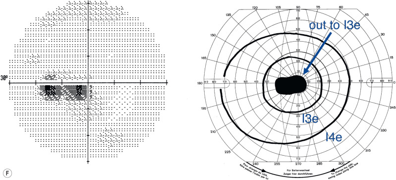 Visual Loss: Optic Neuropathies | Ento Key