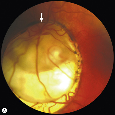 Visual Loss: Optic Neuropathies | Ento Key