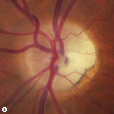 Visual Loss: Optic Neuropathies | Ento Key