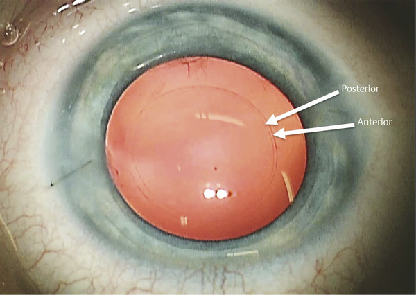 Pediatric Cataract Surgery With The Femtosecond Laser | Ento Key