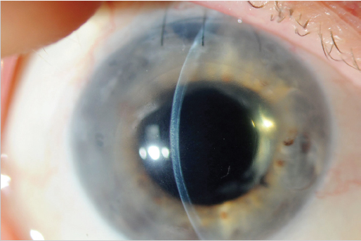 Bullous Keratopathy And Endothelial Keratoplasty | Ento Key