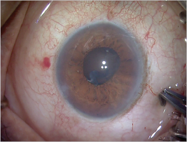 Posterior Capsular Rupture And Intraocular Lens Implantation | Ento Key