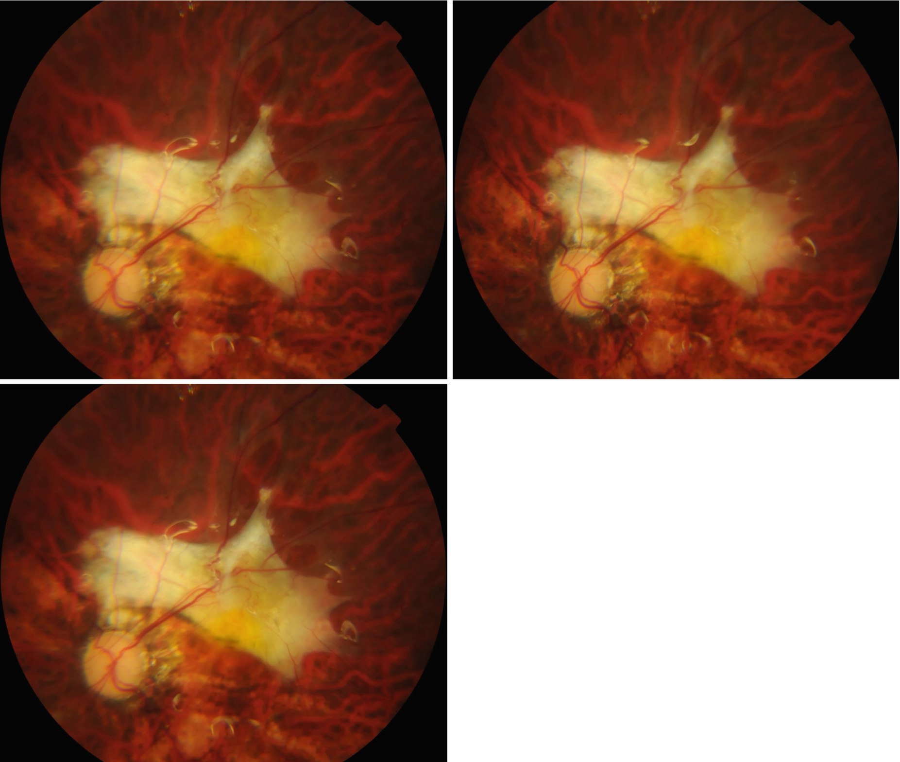 Changes After Vitreoretinal Surgery | Ento Key