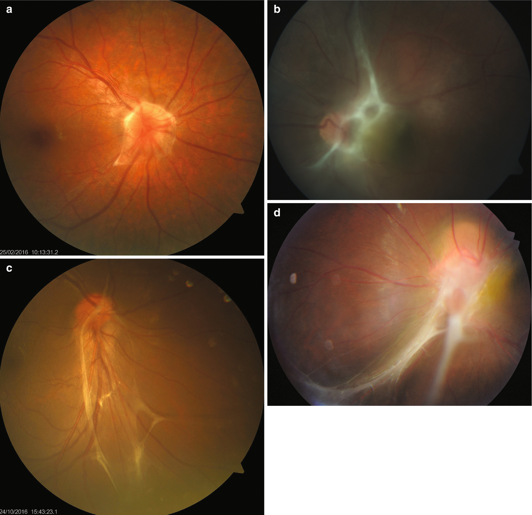 Uveitis | Ento Key