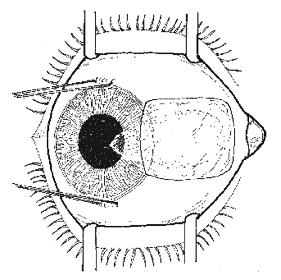 Current Concepts In Treatments Of Pterygium—An Evidence-Based Review ...