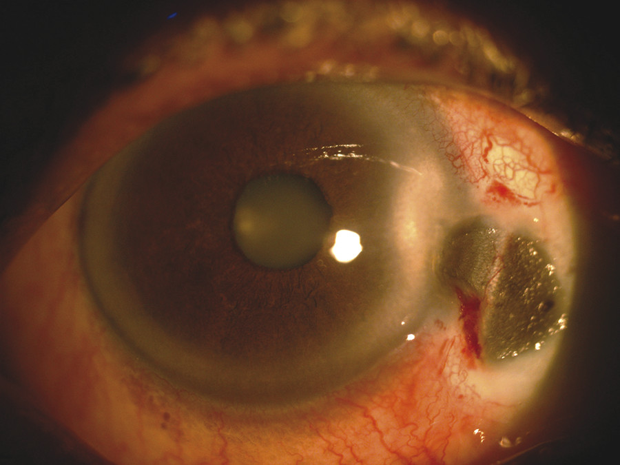 Complications Of Pterygium Surgery | Ento Key