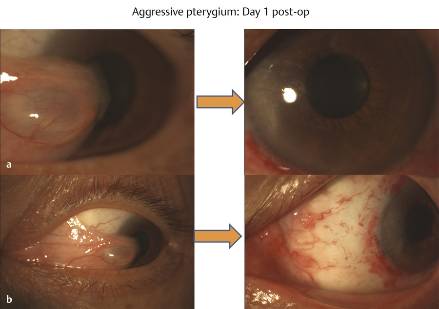 Pterygium And Pinguecula Surgery: Next-Day Cosmetic Outcomes | Ento Key