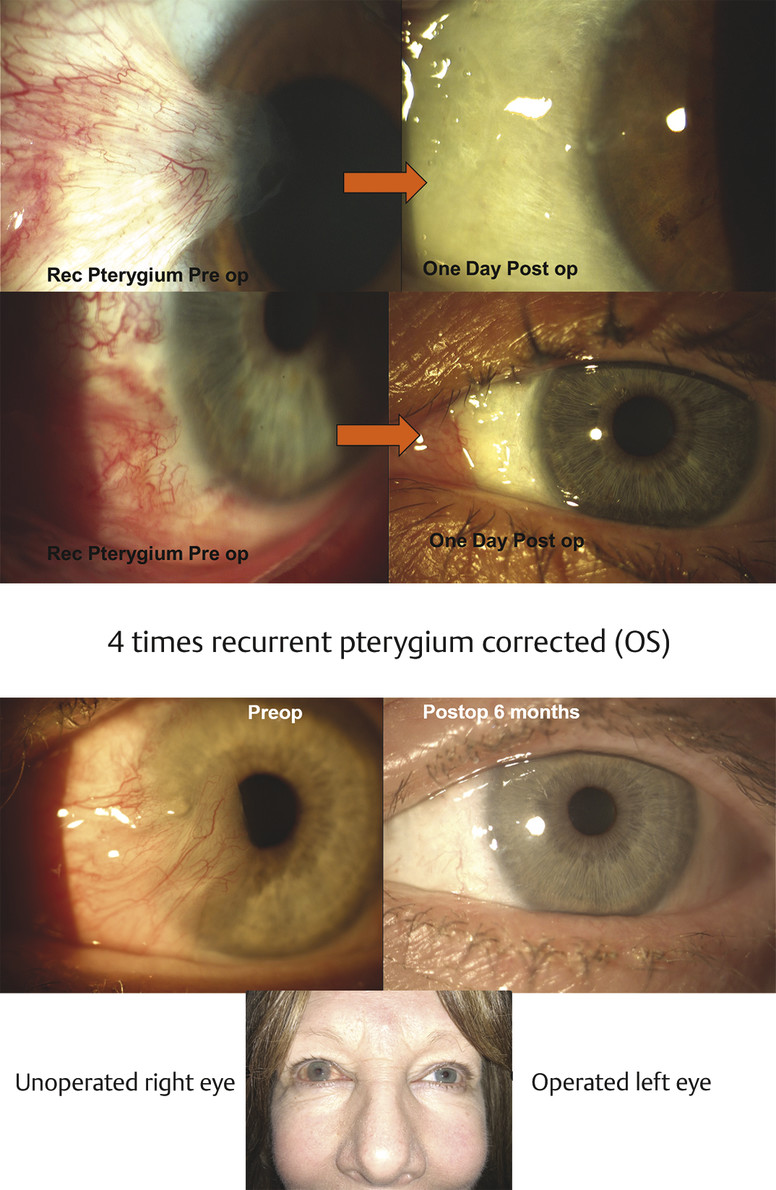 Pterygium And Pinguecula Surgery: Next-Day Cosmetic Outcomes | Ento Key