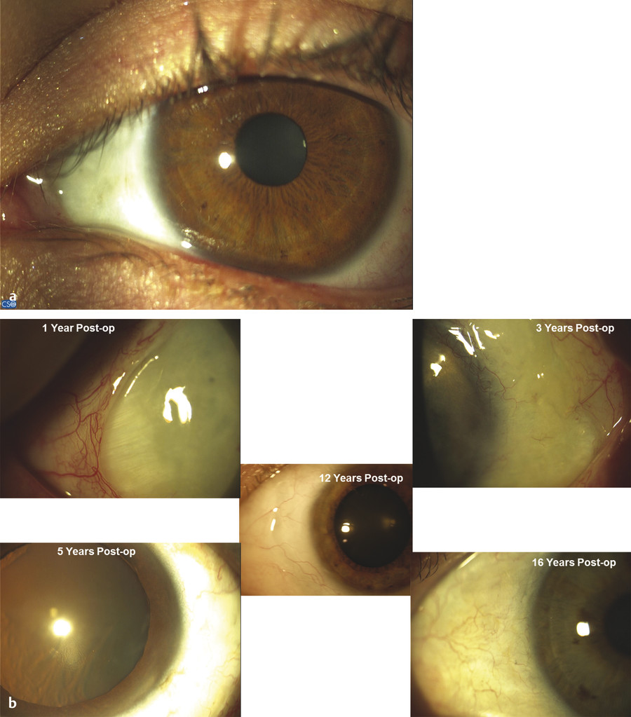 Kerato-Refractive And Premium Cataract Surgery With Pterygium | Ento Key