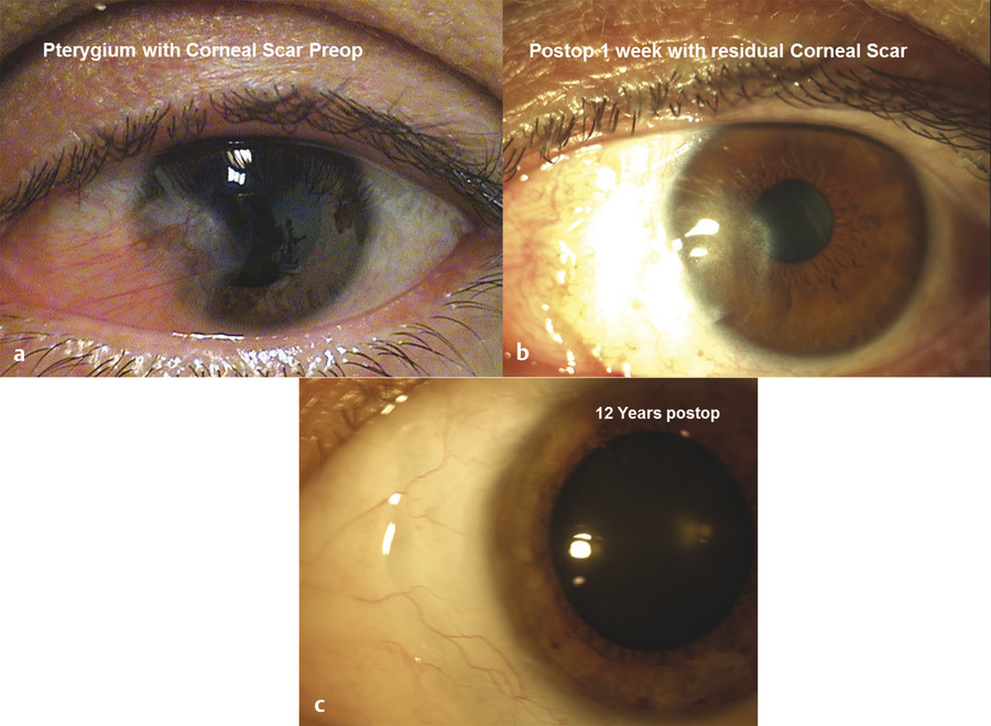 Kerato-Refractive And Premium Cataract Surgery With Pterygium | Ento Key