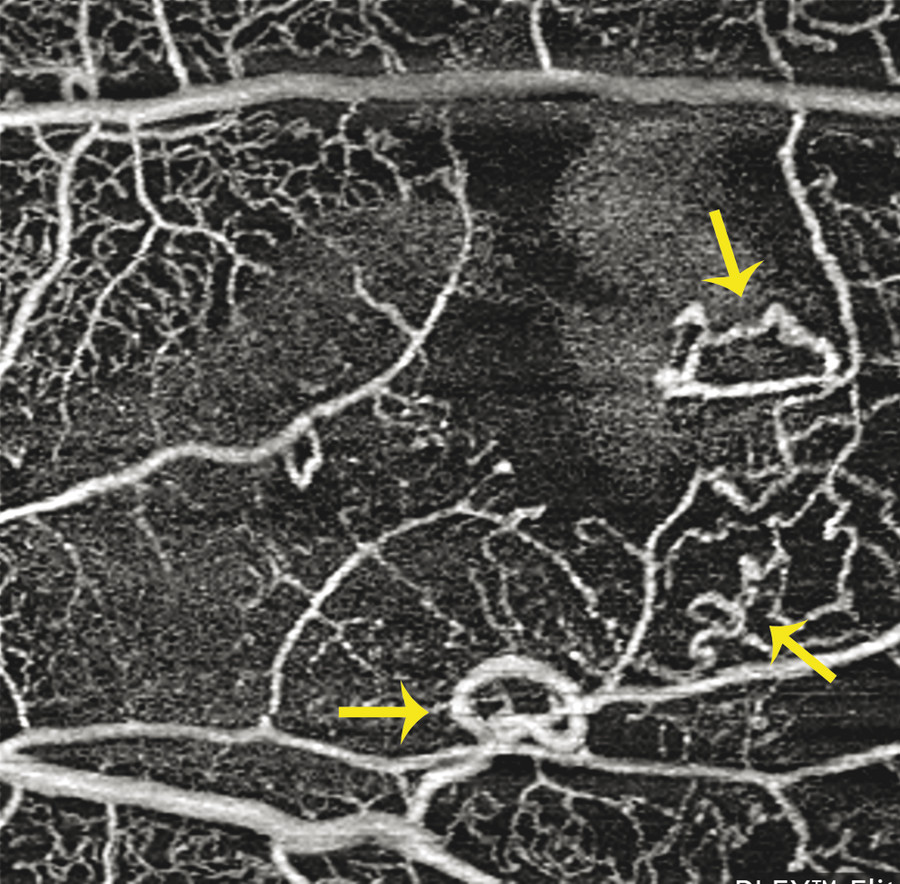 Optical Coherence Tomography Angiography | Ento Key