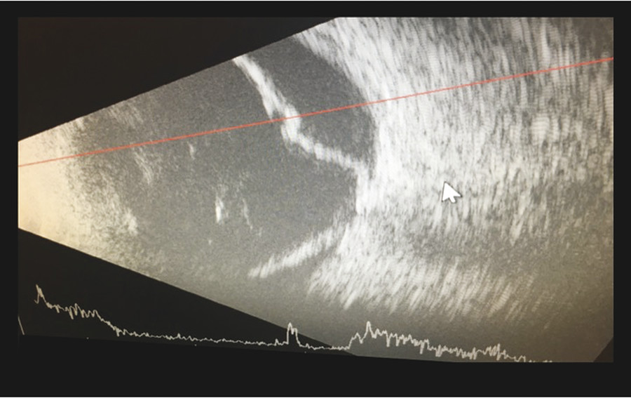 Primary Rhegmatogenous Retinal Detachment | Ento Key