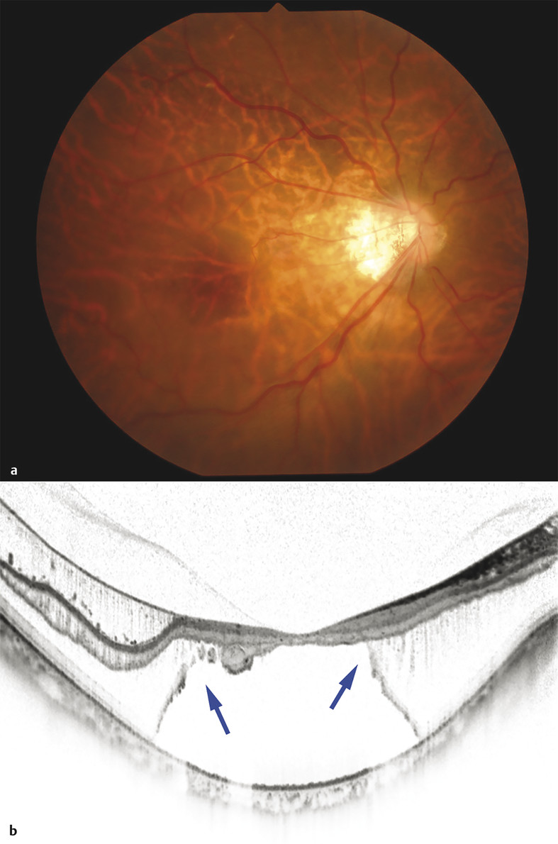 Myopic Degeneration And Myopic Foveoschisis | Ento Key