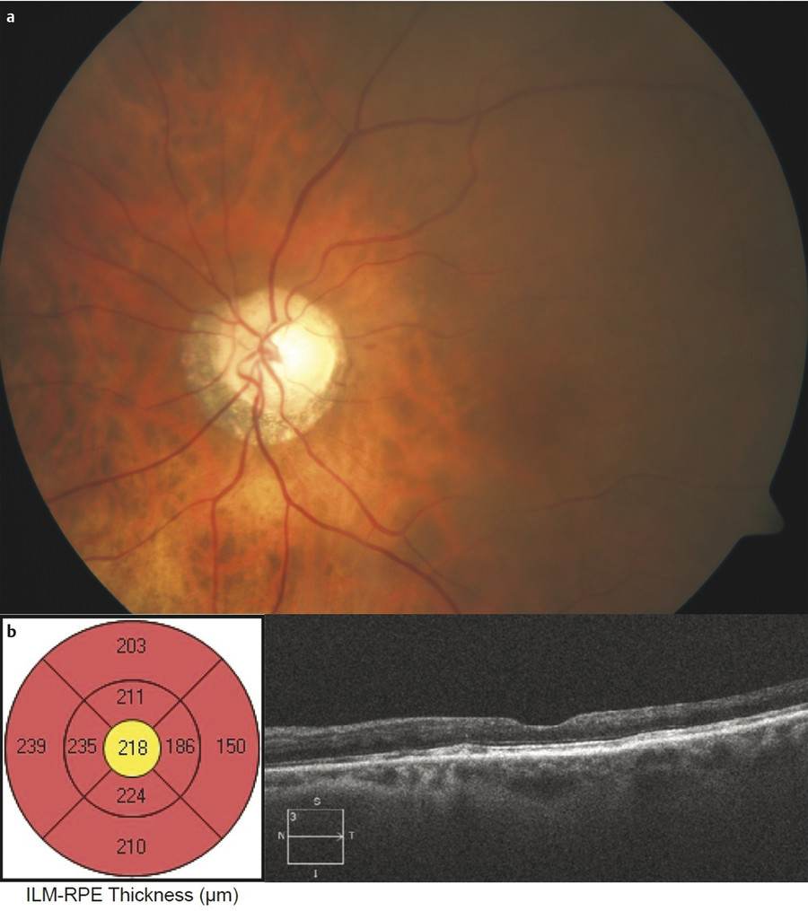 Paraneoplastic Retinopathies | Ento Key