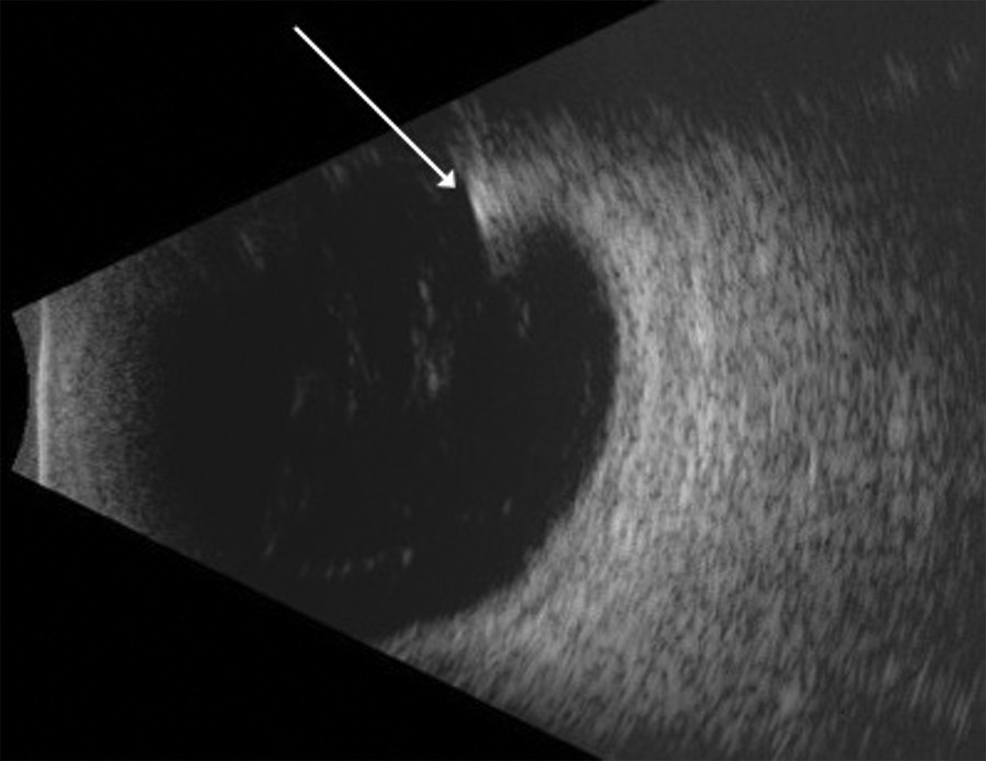 Intraocular Foreign Body | Ento Key