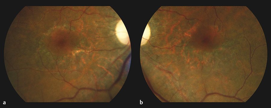 Hydroxychloroquine Retinopathy | Ento Key