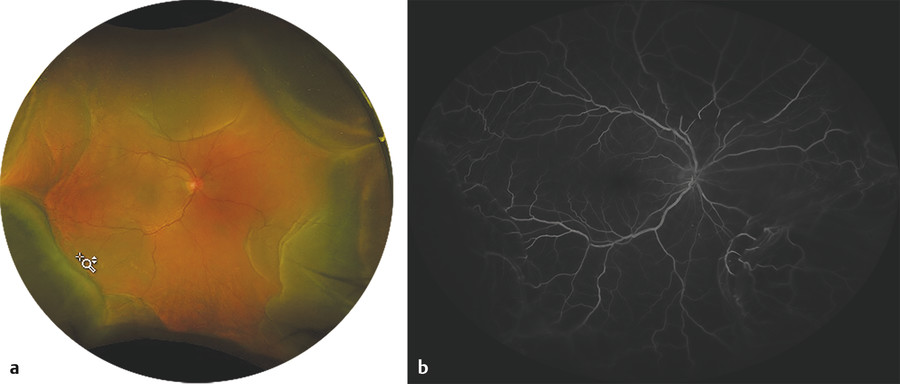 Retinopathy Secondary To Targeted Cancer Therapies | Ento Key