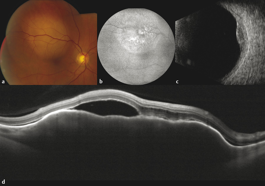 Choroidal And Retinal Metastasis | Ento Key