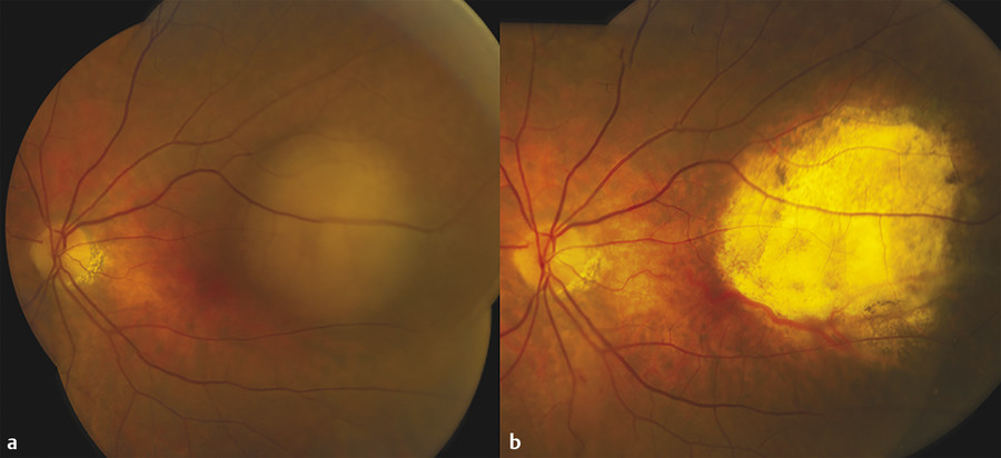 Choroidal And Retinal Metastasis | Ento Key