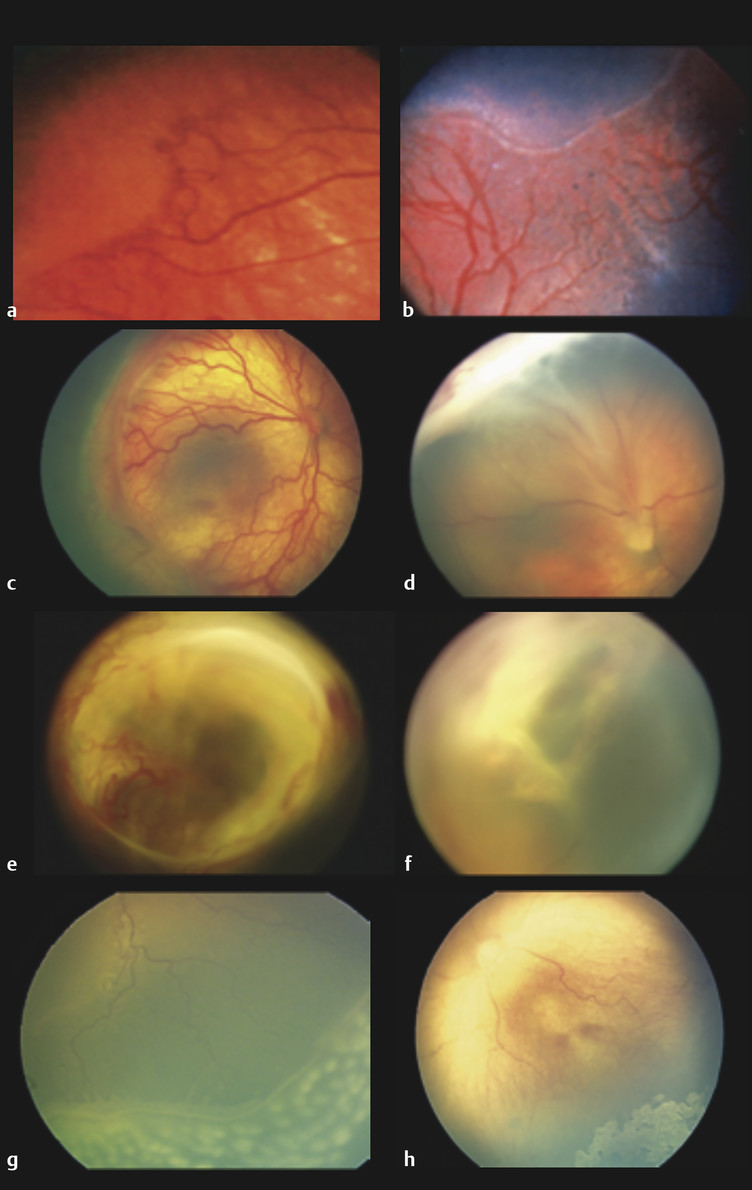 Retinopathy Of Prematurity | Ento Key