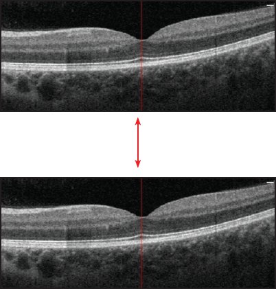 Optical Coherence Tomography Angiography Overview | Ento Key