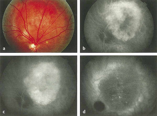 4 Fundus Angiography | Ento Key