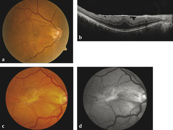 18 Epiretinal Membrane And Vitreomacular Traction | Ento Key