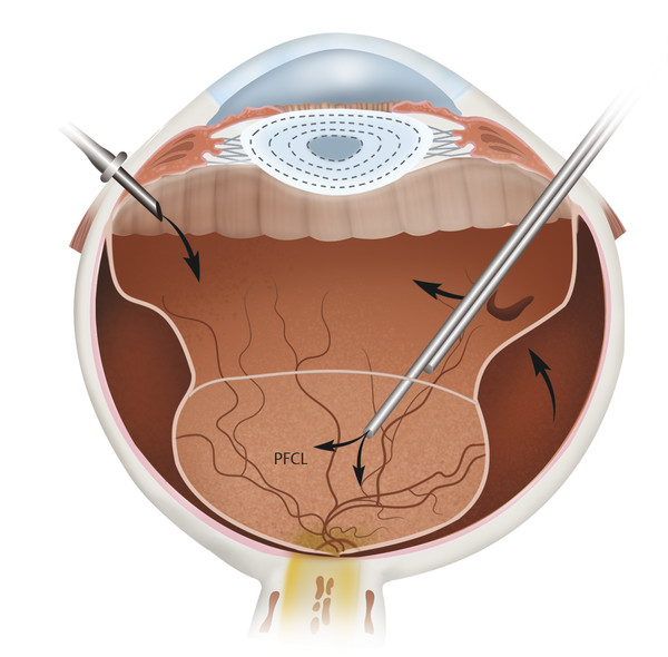 40 Vitreous Surgery | Ento Key