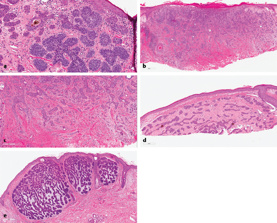 11 Role Of Dermatopathology In The Surgical Management Of Skin Cancer ...