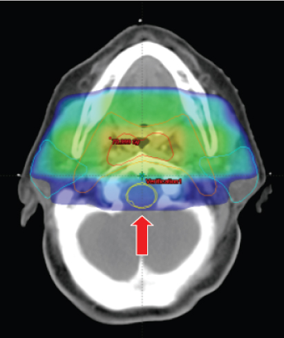 Nasopharyngeal Carcinoma | Ento Key