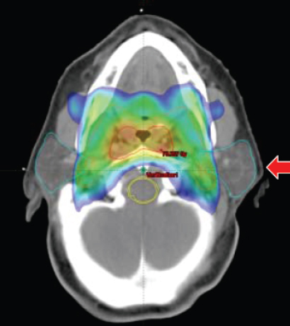 Nasopharyngeal Carcinoma | Ento Key