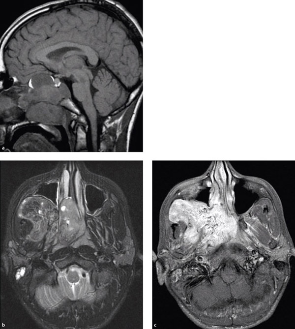 Imaging Of The Paranasal Sinuses And Nasopharynx | Ento Key