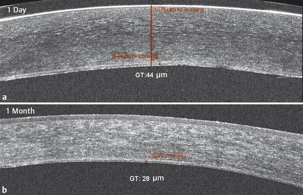 13 Spectral-Domain Optical Coherence Tomography Evaluation Of Pre ...