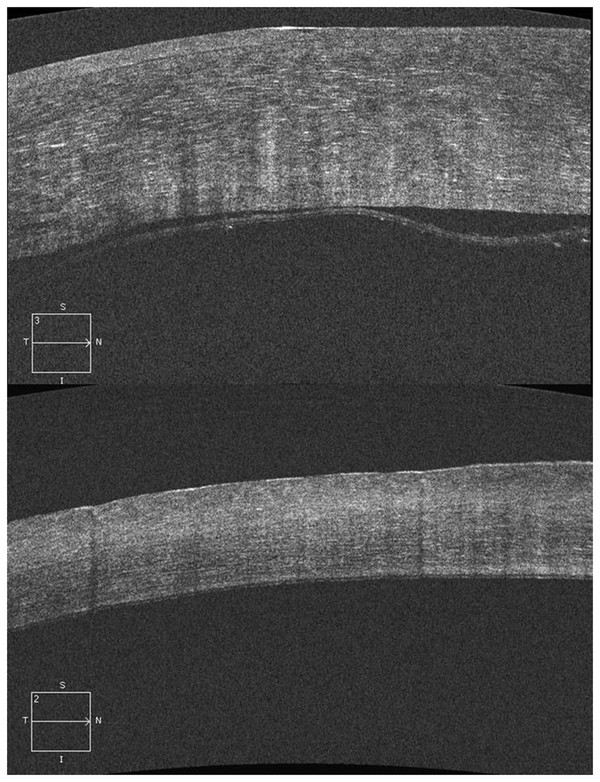 13 Spectral-Domain Optical Coherence Tomography Evaluation Of Pre ...