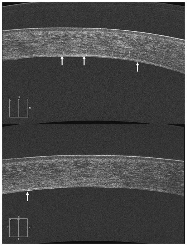 13 Spectral-Domain Optical Coherence Tomography Evaluation Of Pre ...