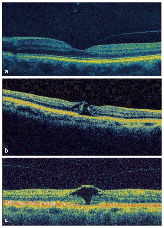 21 Optical Coherence Tomography Diagnosis Of Macular Diseases | Ento Key