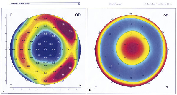 8 Optimizing IOL Selection After Corneal Refractive Surgery | Ento Key