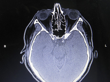 Evaluation And Management Of Acquired Nasolacrimal Duct Obstruction ...