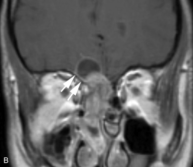 Endoscopic Endonasal Approaches To The Orbit And Skull Base In The ...