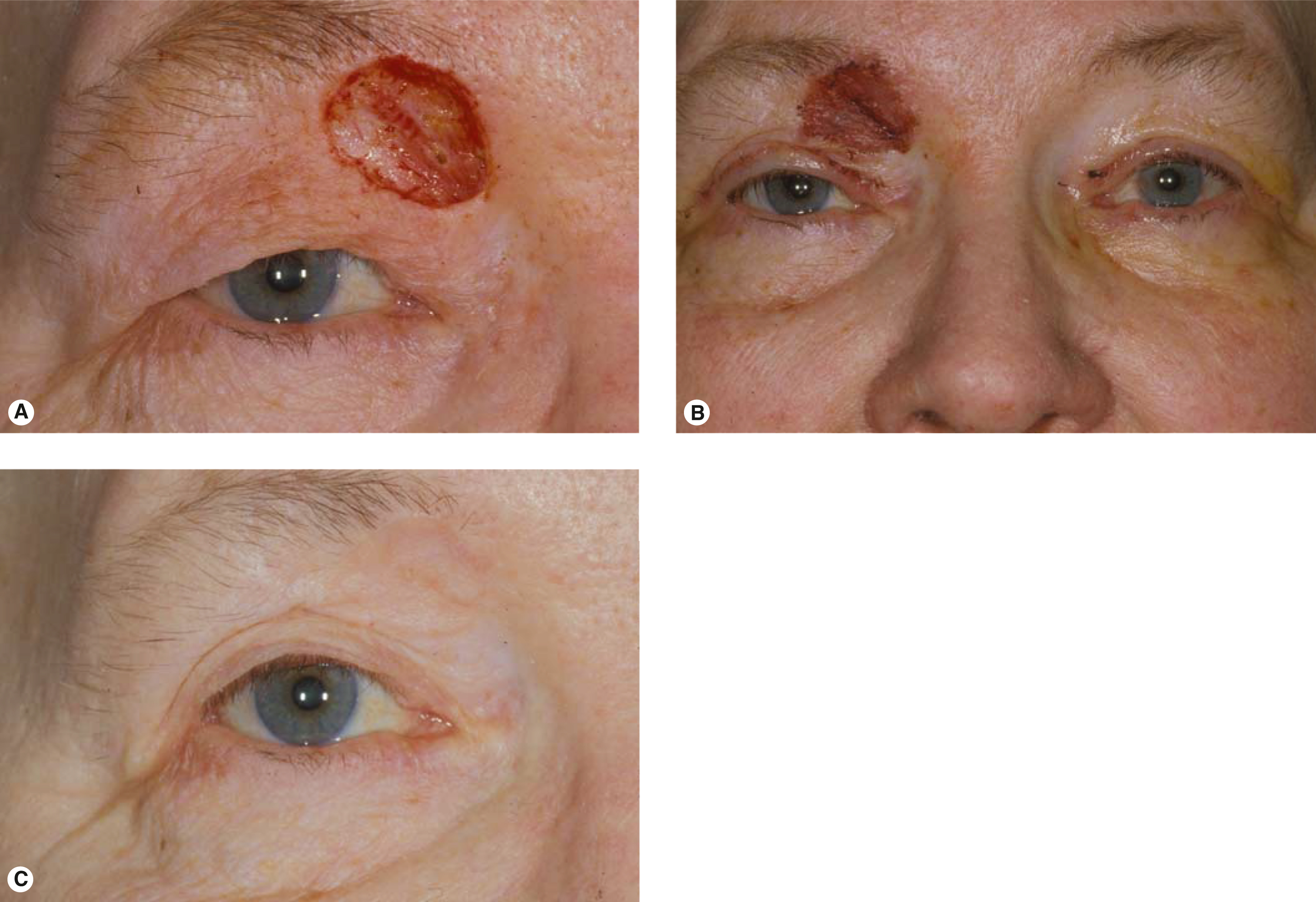 Eyelid Reconstruction | Ento Key