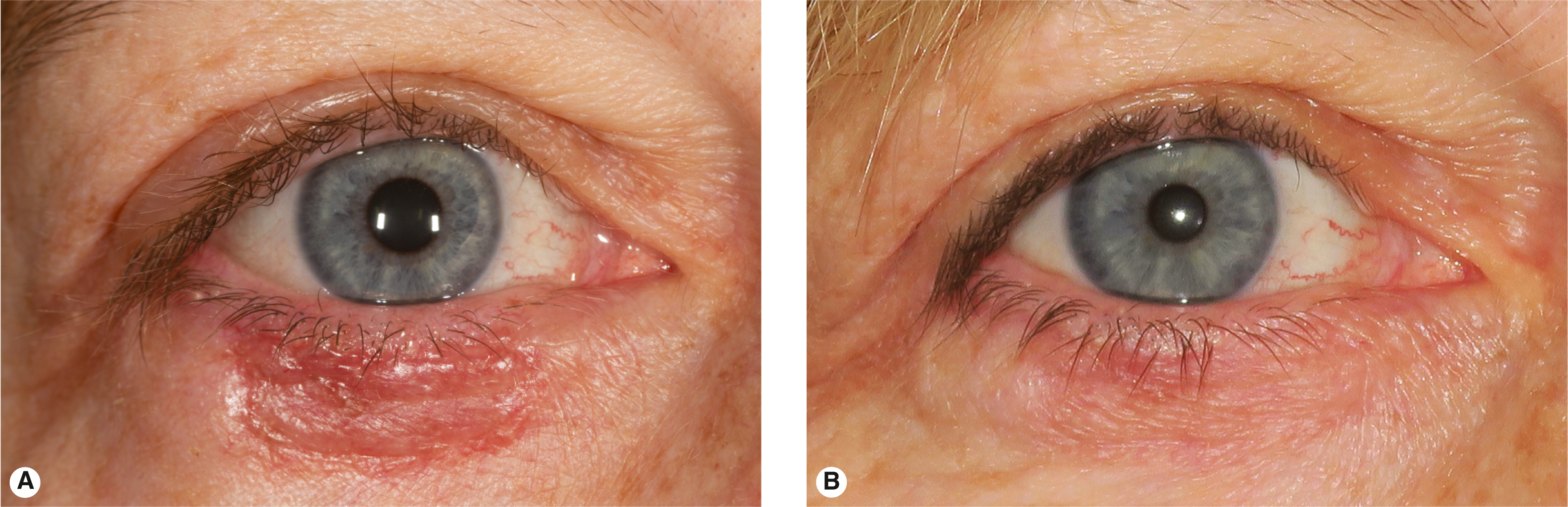 Eyelid Reconstruction | Ento Key