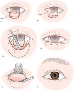 Lower Eyelid Reconstruction | Ento Key