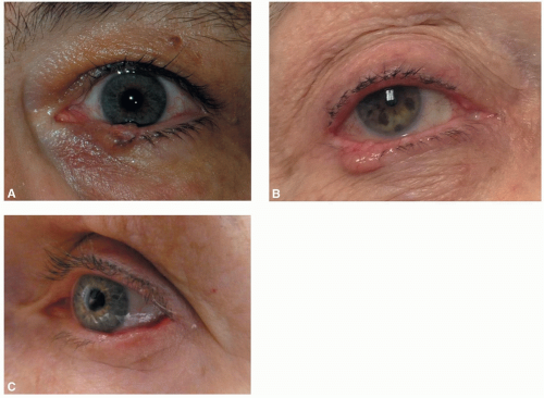 Management Of Malignant Eyelid Lesions | Ento Key