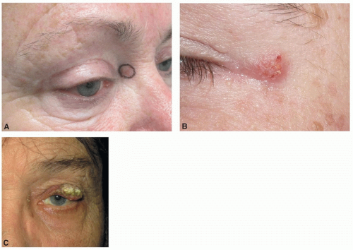 Management Of Malignant Eyelid Lesions | Ento Key