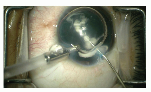 Medications In Pediatric Cataract Surgery | Ento Key