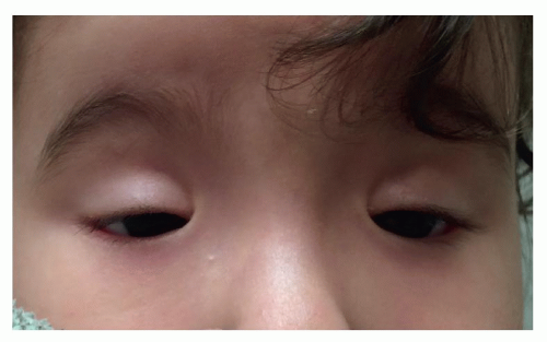 Pediatric Ptosis Repair: Blepharophimosis Syndrome | Ento Key