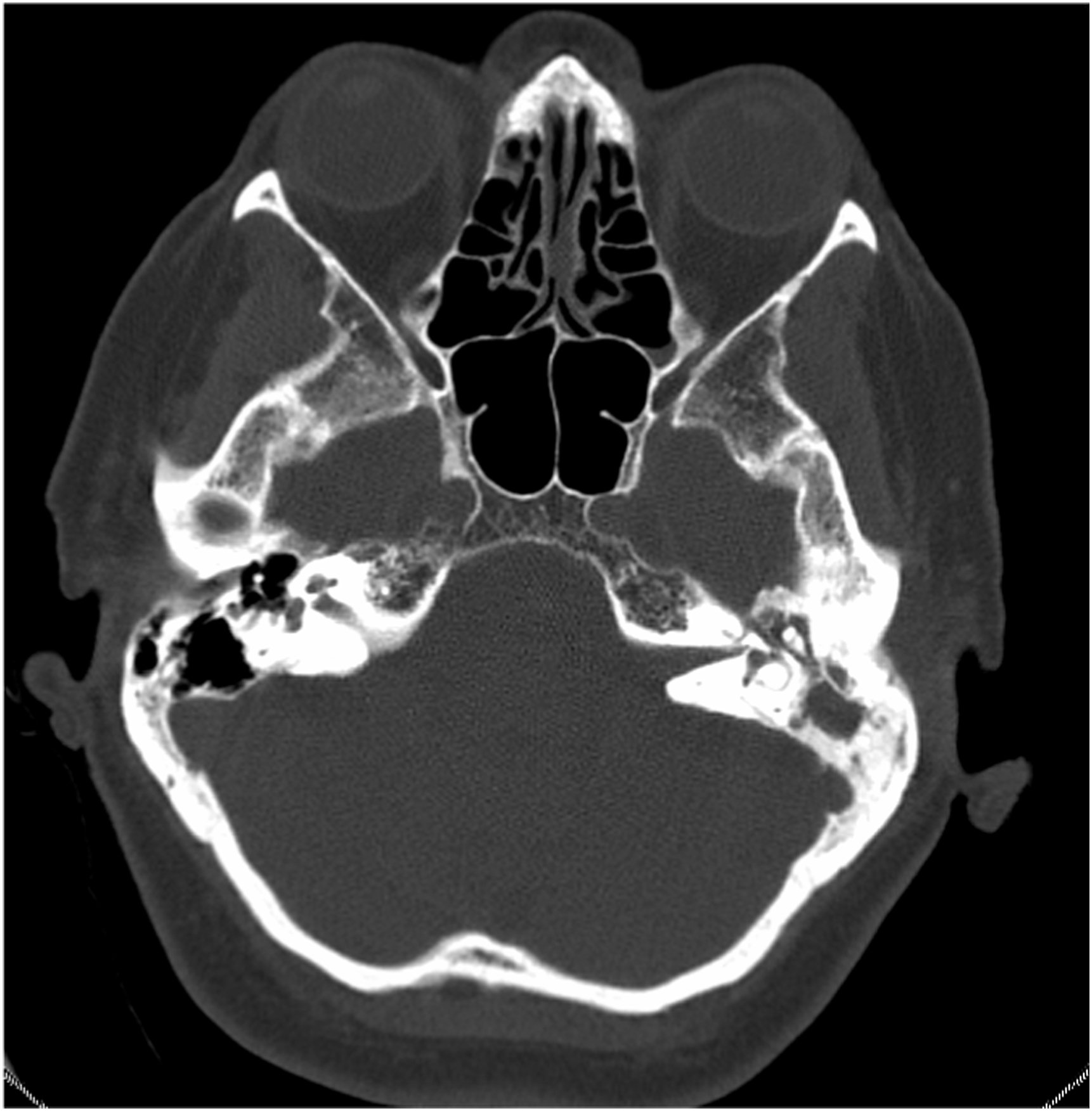 Late Onset Middle Ear Neuroendocrine Tumor Presenting With Distant ...