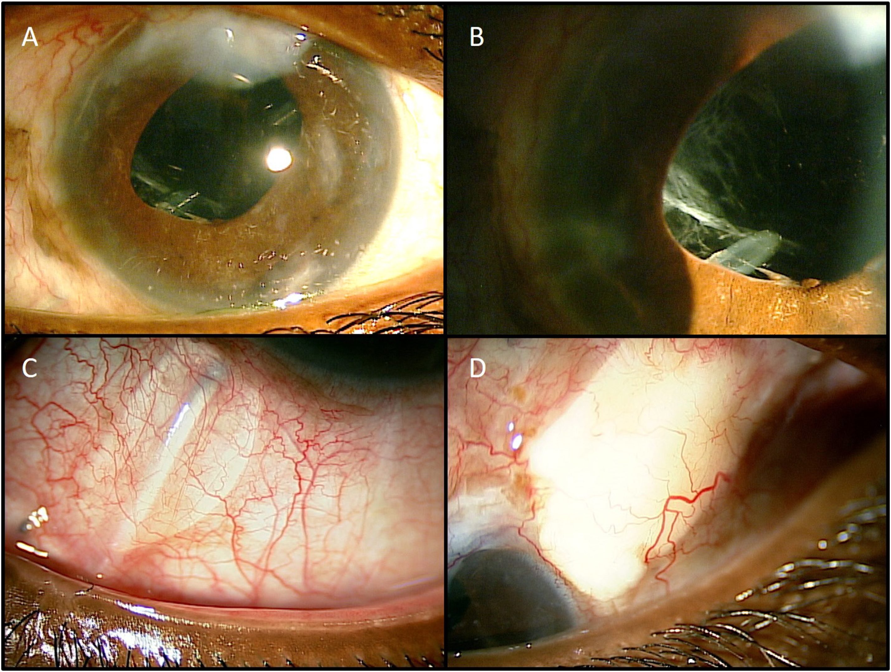 Management Of Severe Epithelial Versus Fibrous Downgrowth Following ...